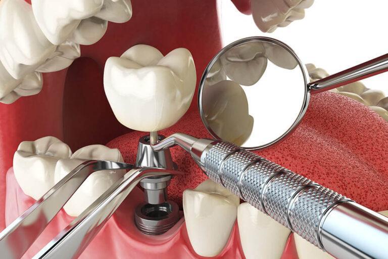 dental implants