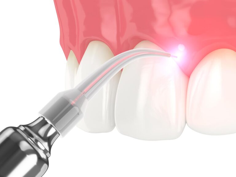 dental cleaning
